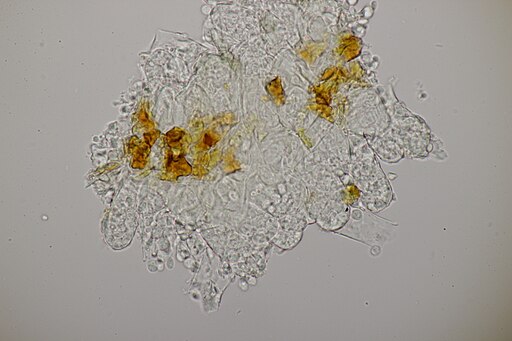Erlen-Narrentasche, Taphrina alni